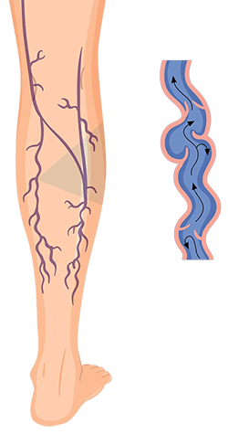 Varicose Leg